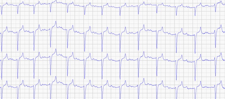 ecg